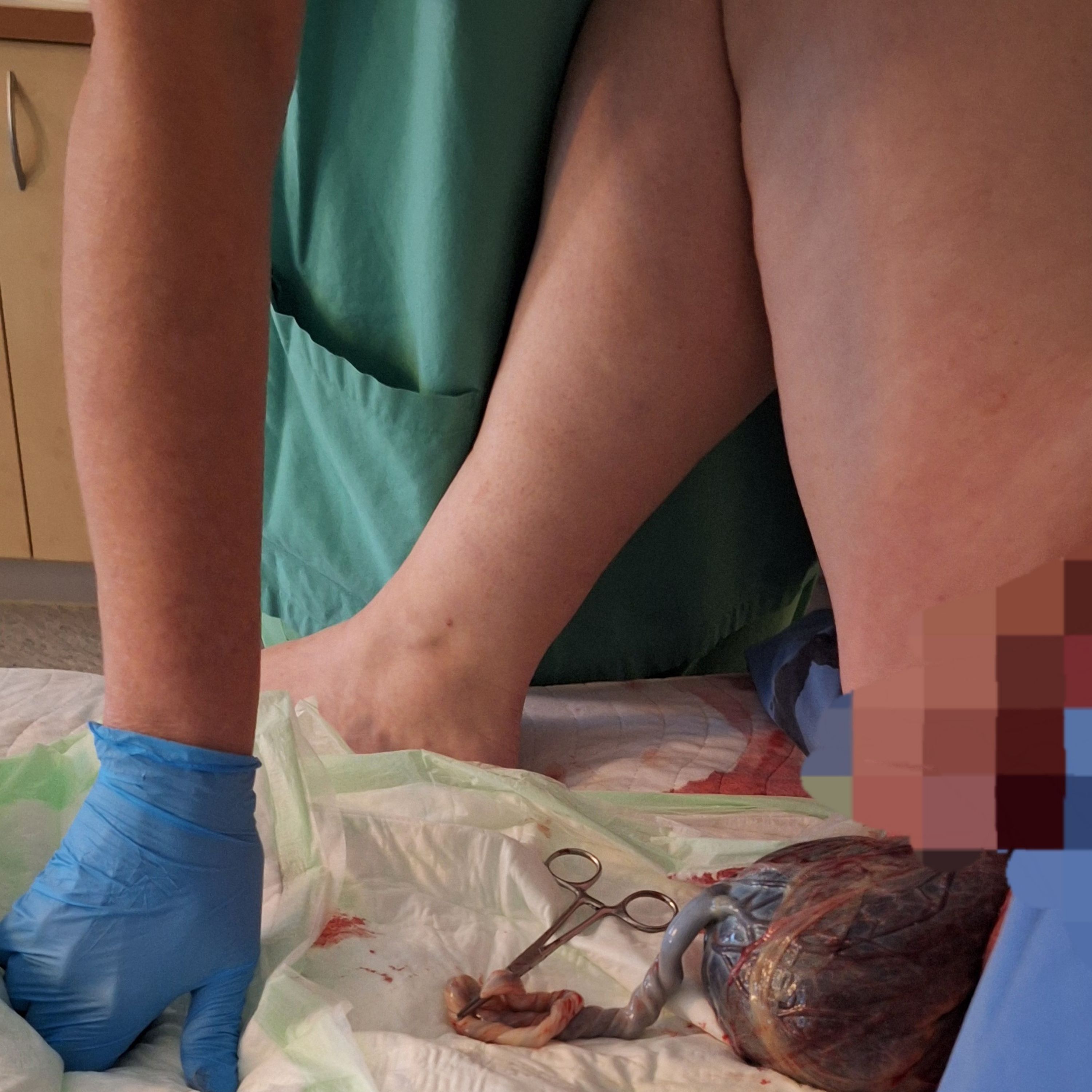 197 | Anna - Hoher BMI, Geplante Sectio, Ambulante VBAC mit 4240g Baby, Doulabegleitung