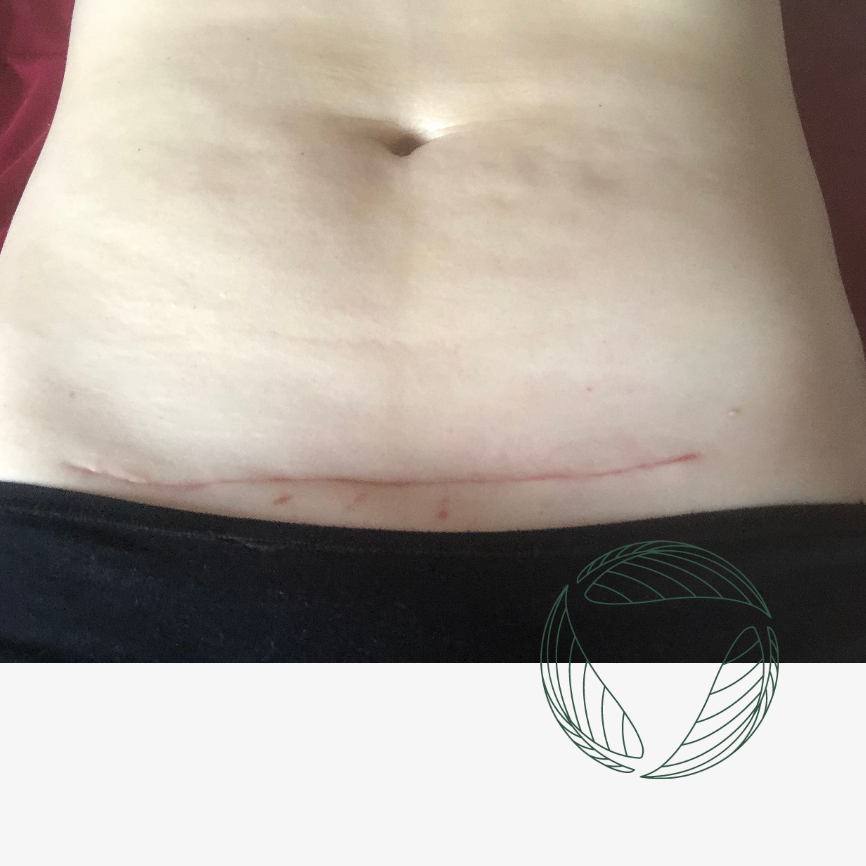 201 | Theas Wochenbett und Heilung von Narbengewebe