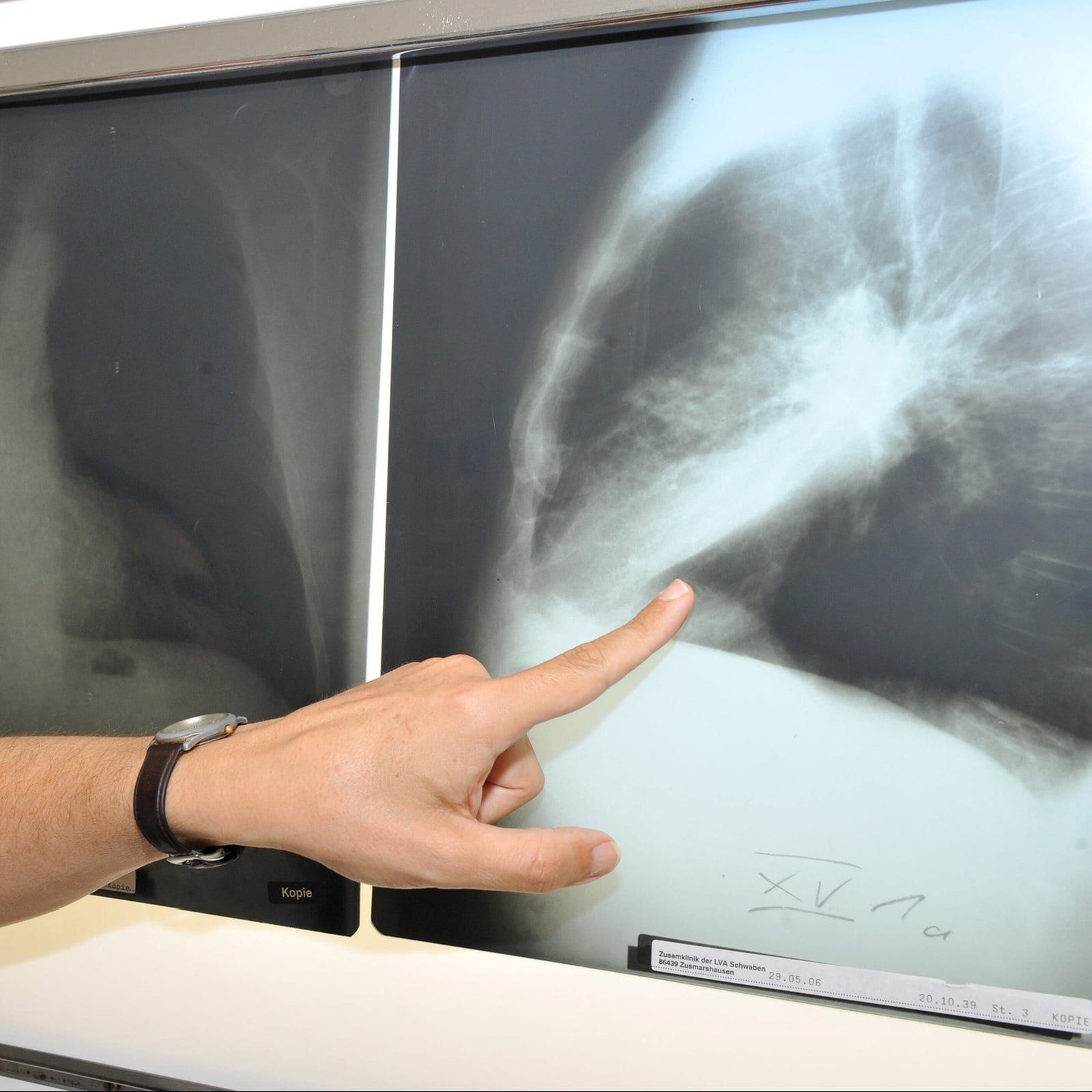 Ab April: Kostenlose Krebsvorsorge für Starkraucher