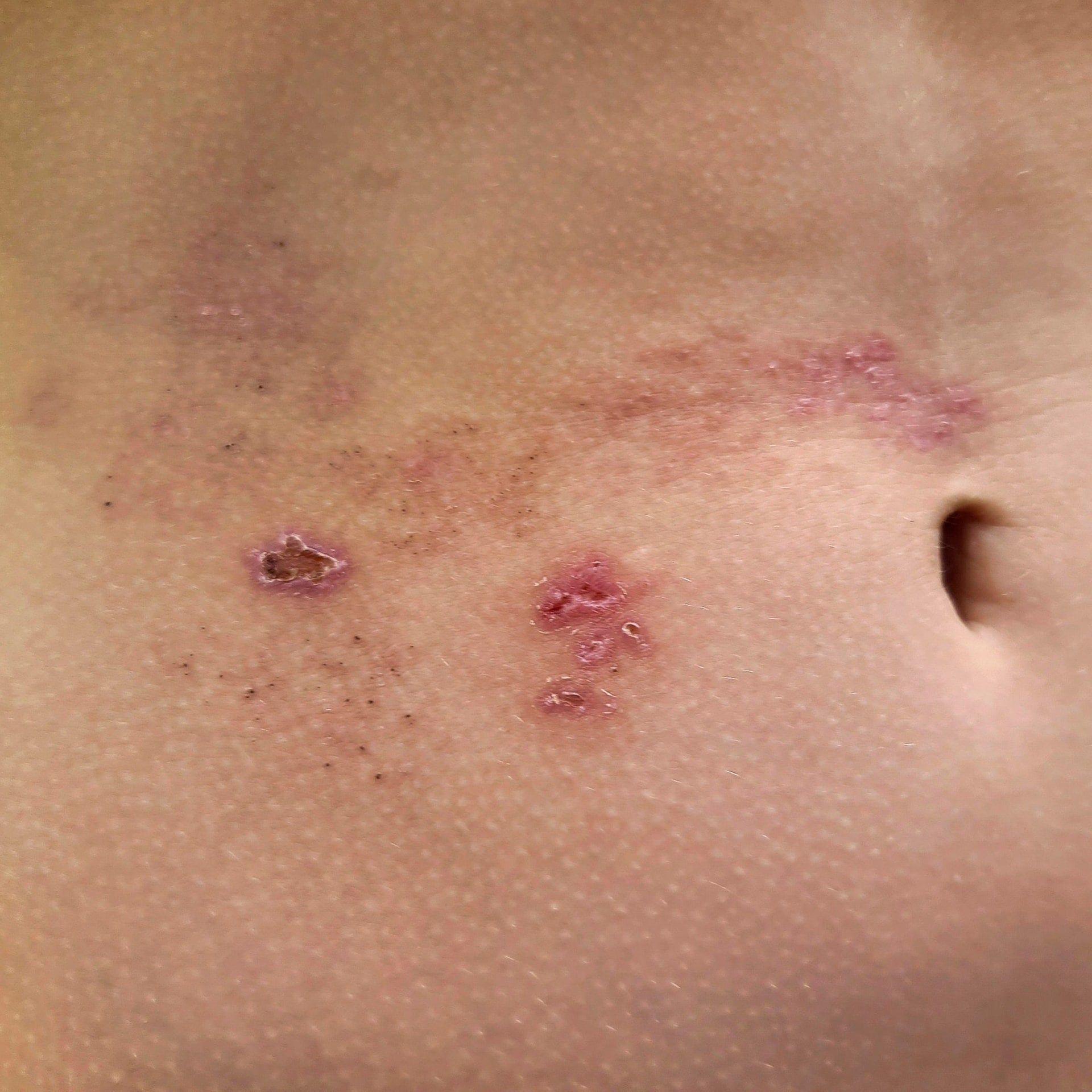 Bei einer Gürtelrose ist immer nur eine Hautpartie befallen – warum?