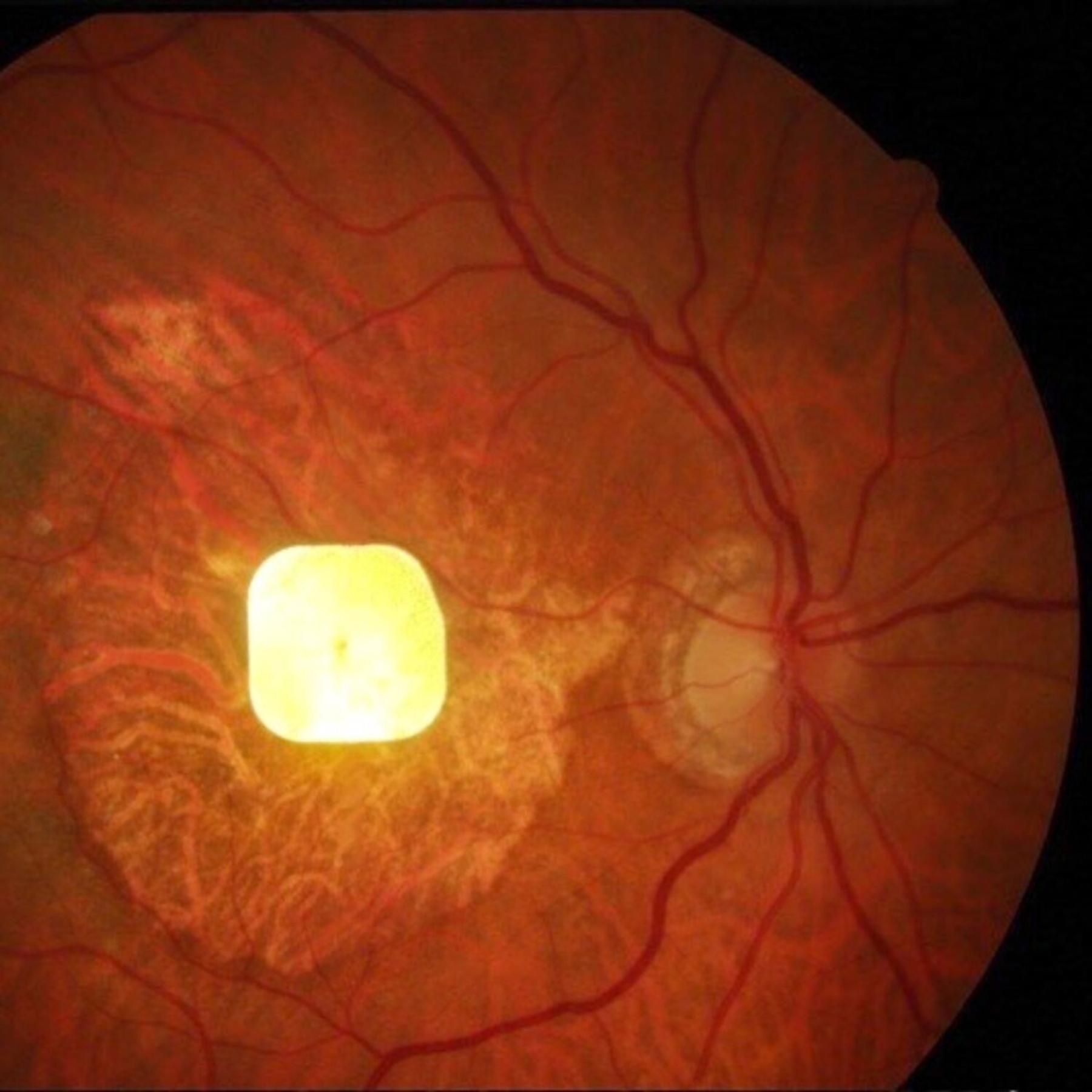 Chip im Auge - Hilft er im Kampf gegen Makula-Degeneration?