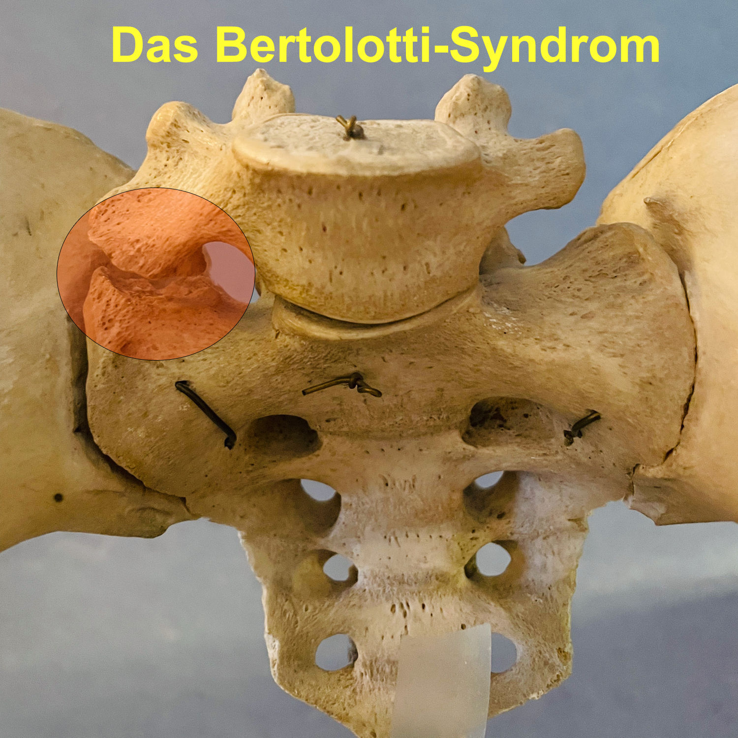 Das Bertolotti-Syndrom – ein unterschätzter Auslöser von Rückenschmerzen