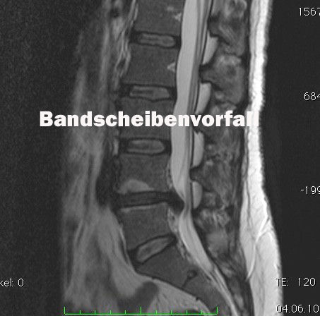 Der Bandscheibenvorfall an der Lendenwirbelsäule