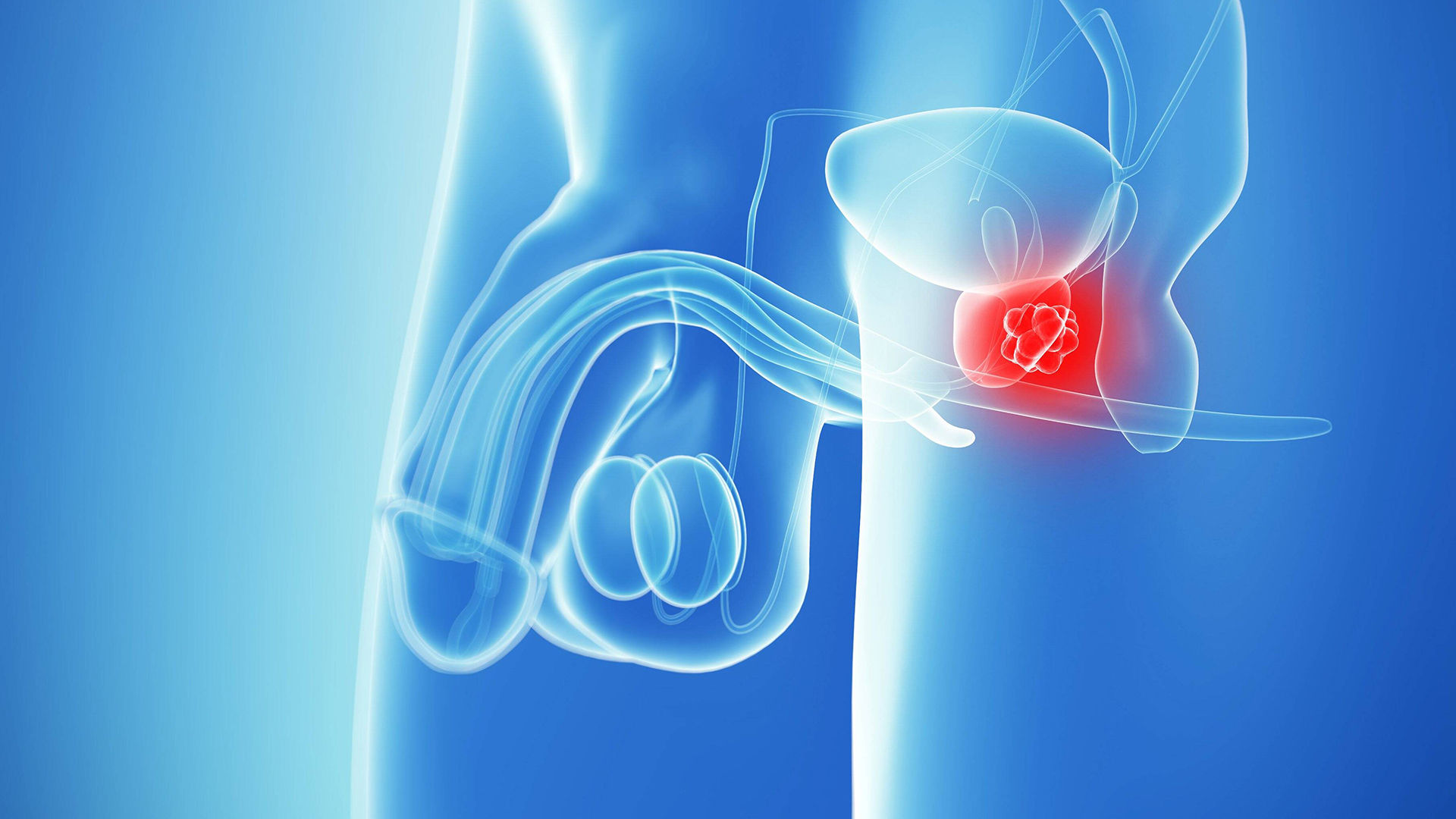 Diagnose Prostatakrebs - Mein Tumor als Rechercheobjekt