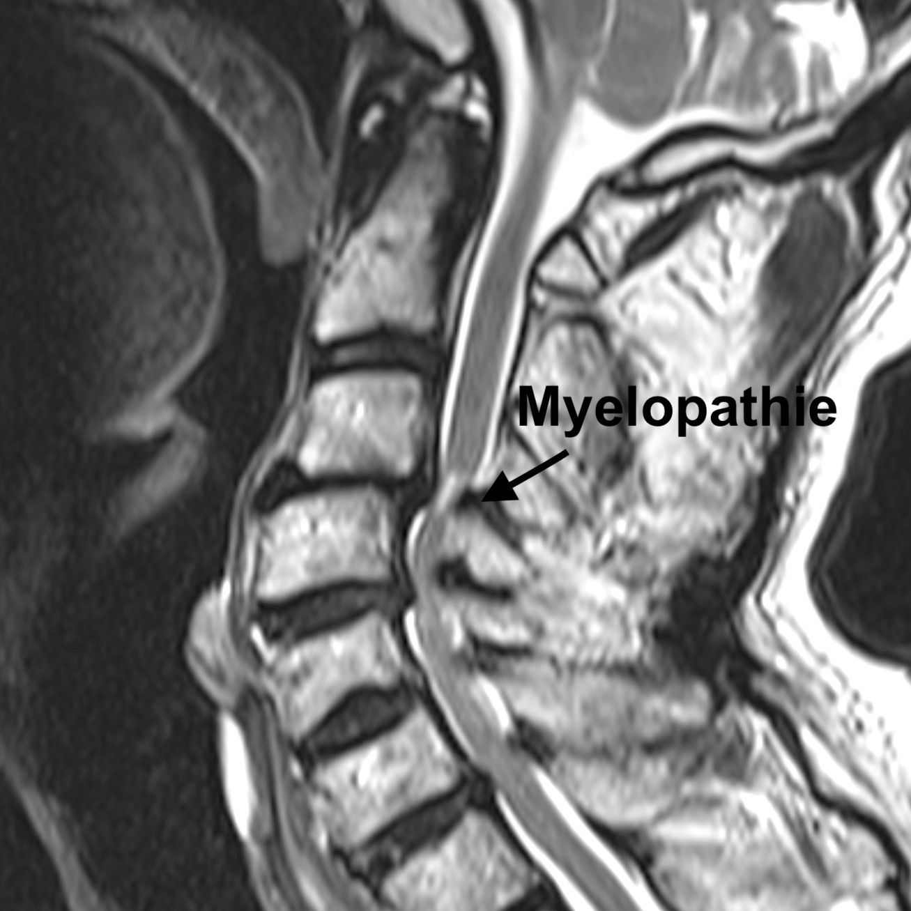 Die Spinalkanalstenose - Einengung des Wirbelkanals an der Halswirbelsäule