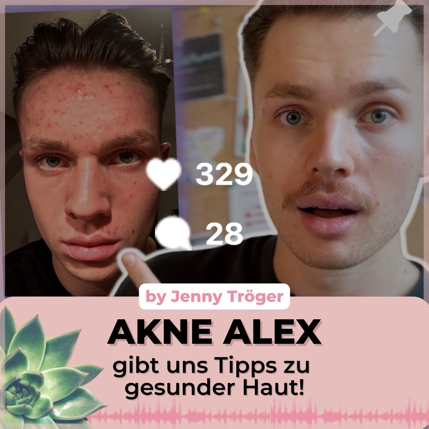 Endlich schöne Haut! "Akne" Alex verrät seine besten Tipps rund um Ernährung & Skincare!