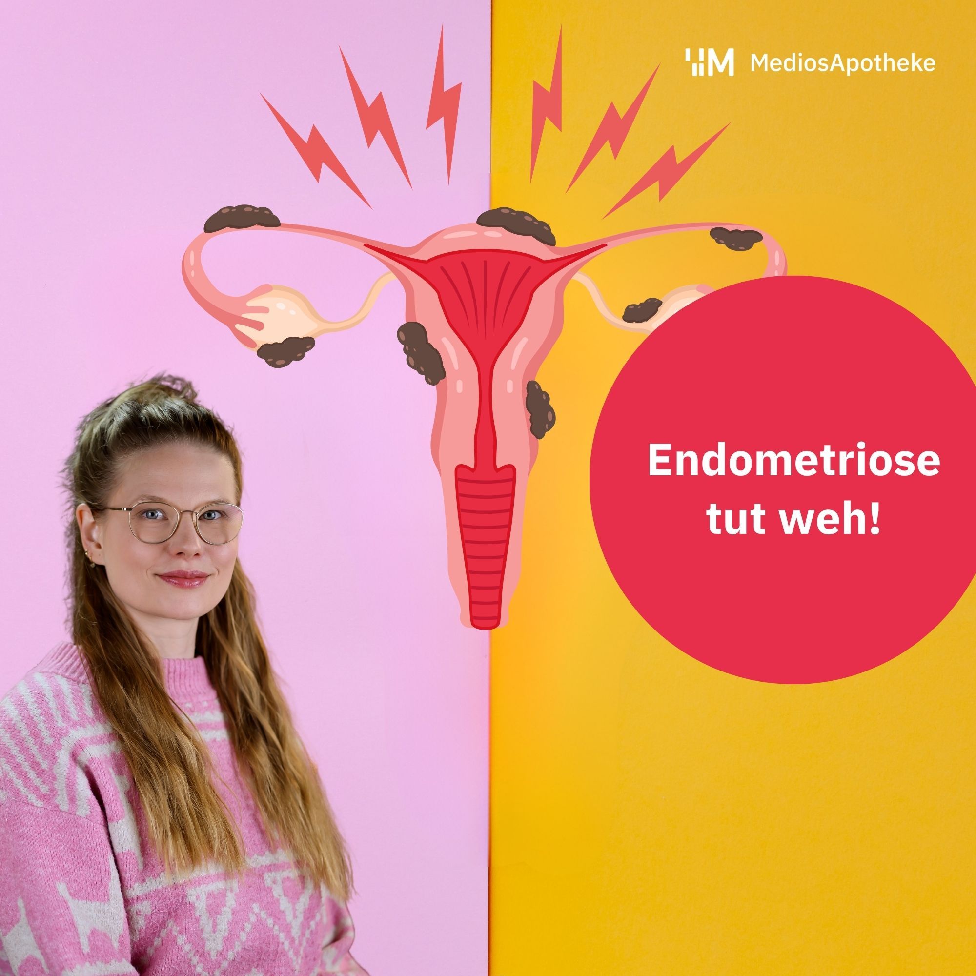 Endometriose: Schmerzchaos; diffuse Regelschmerzen; alles, nur nicht „normal“? Das musst du wissen!