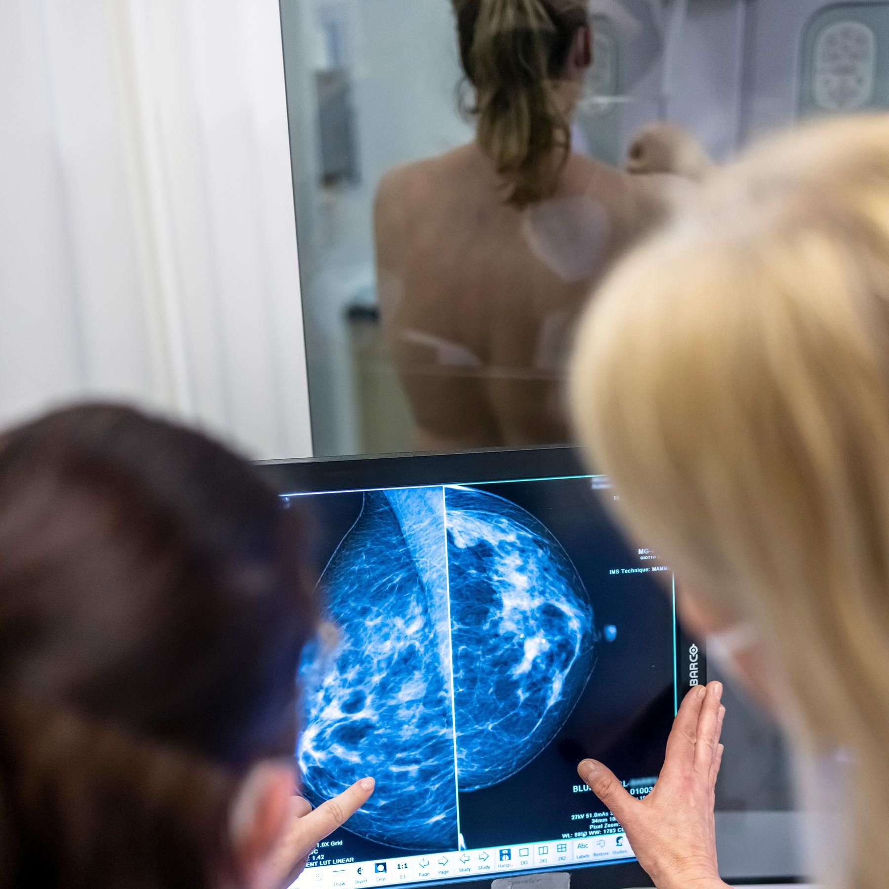 Kampf gegen Brustkrebs - Was bringt das Mammographie-Screening?