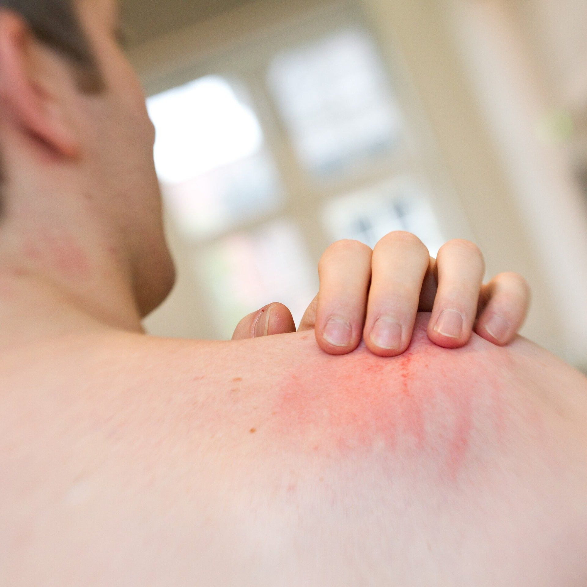 Neue Mittel gegen die Volkskrankheit Juckreiz