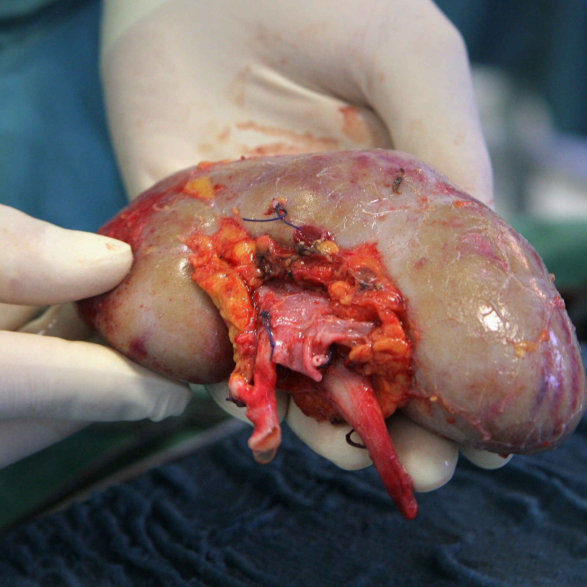 Nierentransplantation: Was ist in Zukunft möglich?