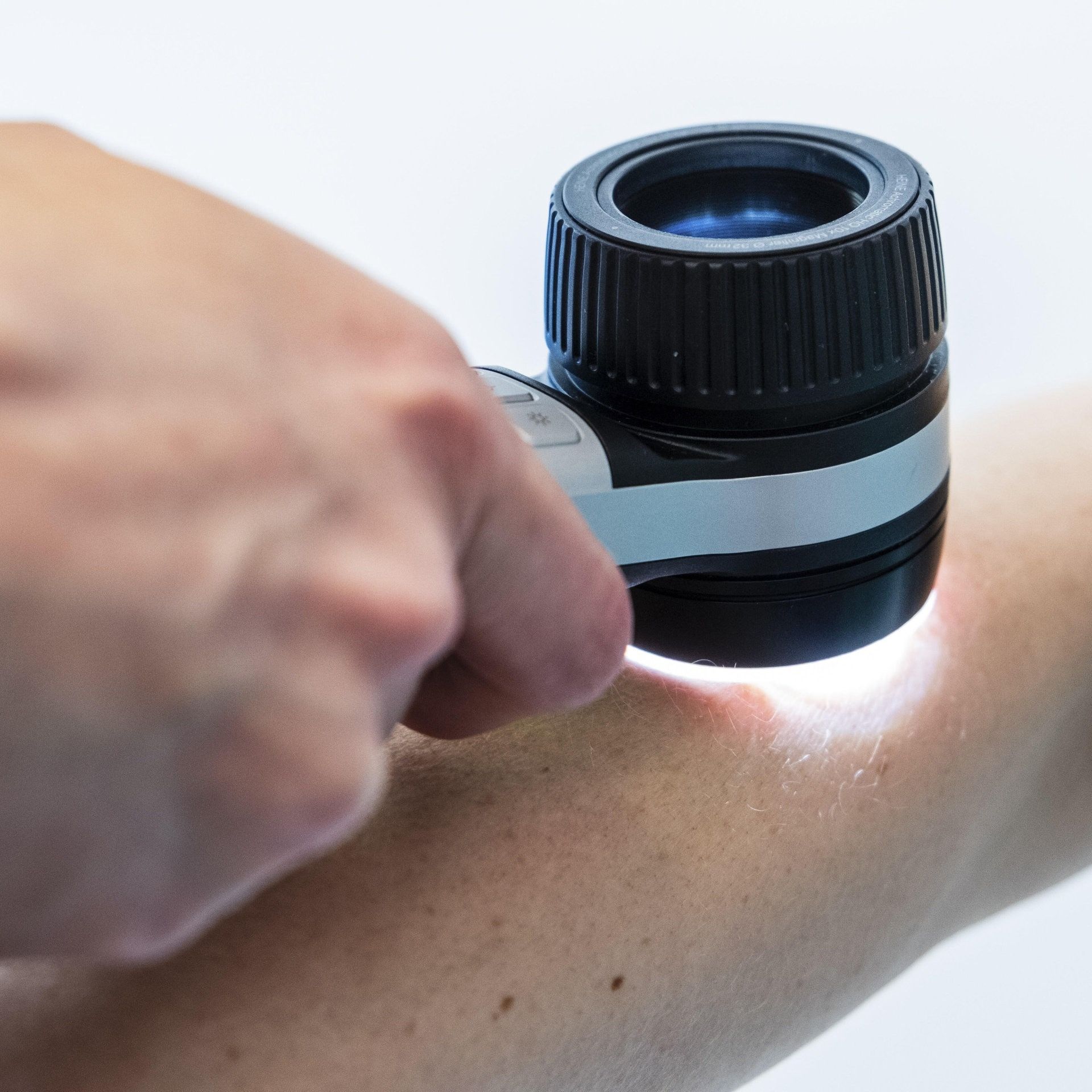 Nur wenige gehen zur Hautkrebs-Vorsorge - warum ein Check sinnvoll ist