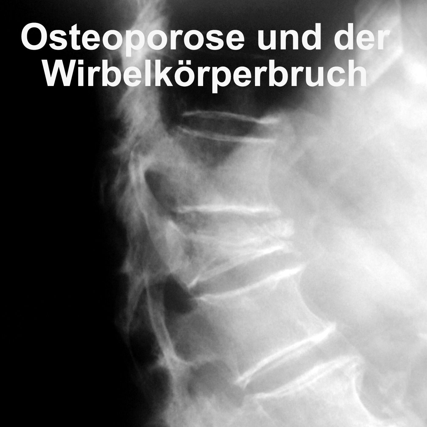 Osteoporose - der Knochenschwund beginnt früher, als Sie denken