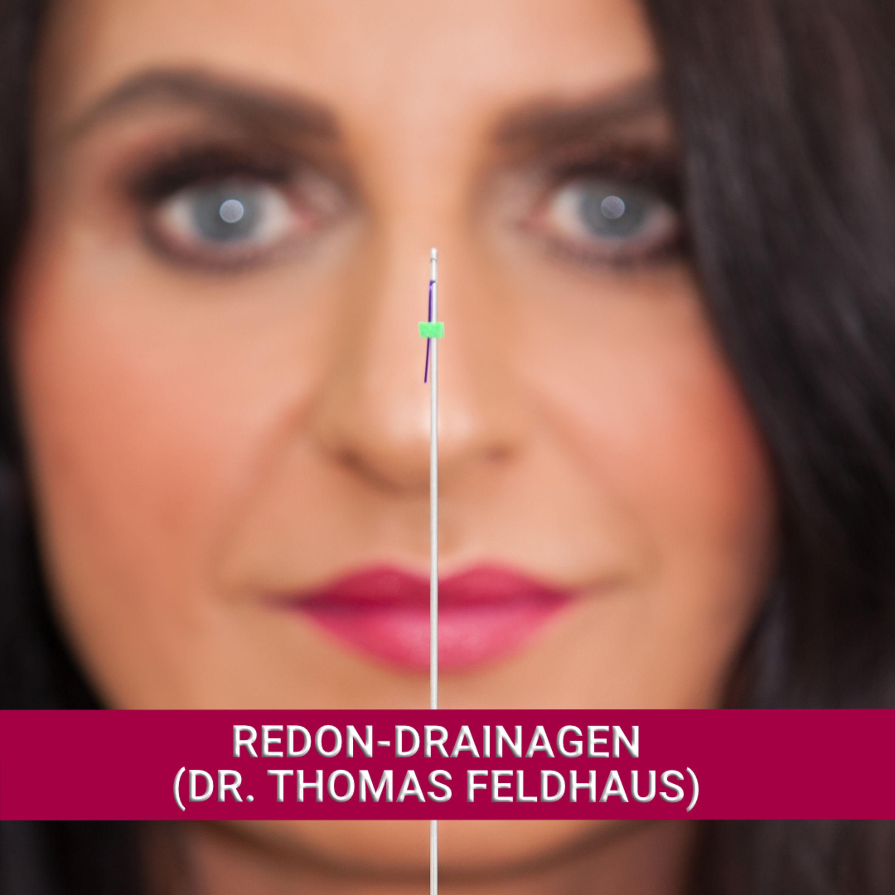 Redon-Drainagen (Dr. Thomas Feldhaus)