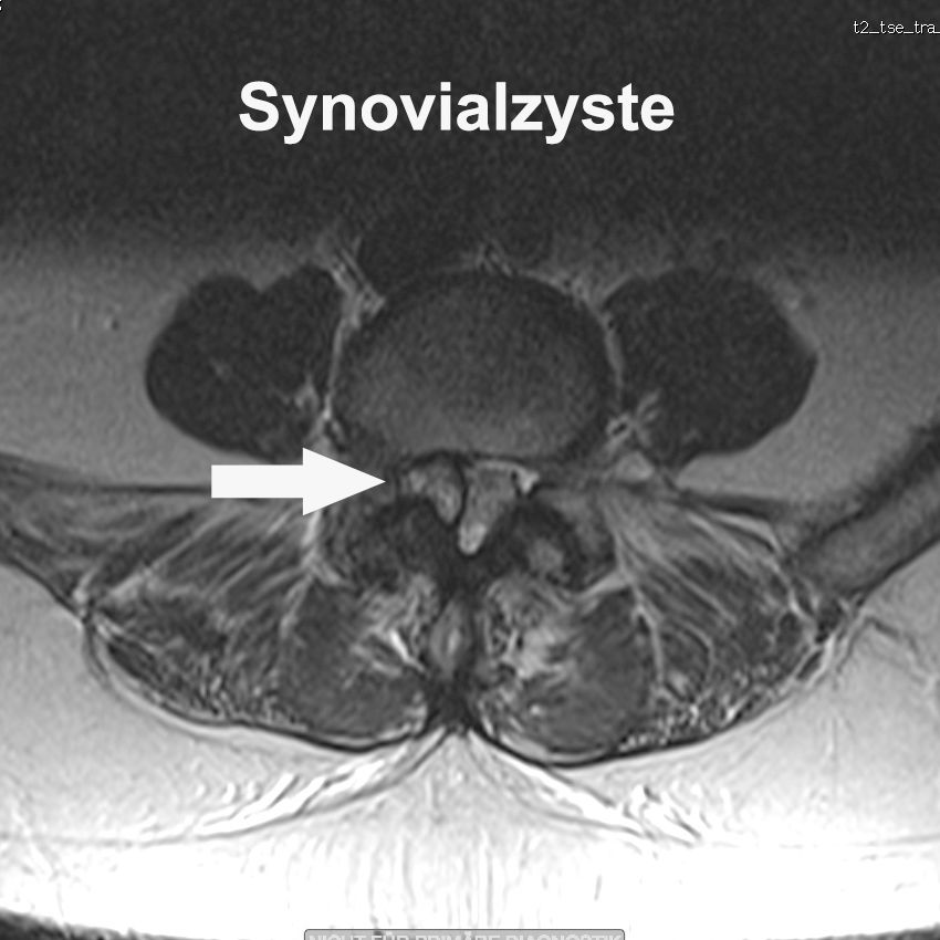 Synovialzysten - Wenn Schleimblasen auf Nerven drücken.