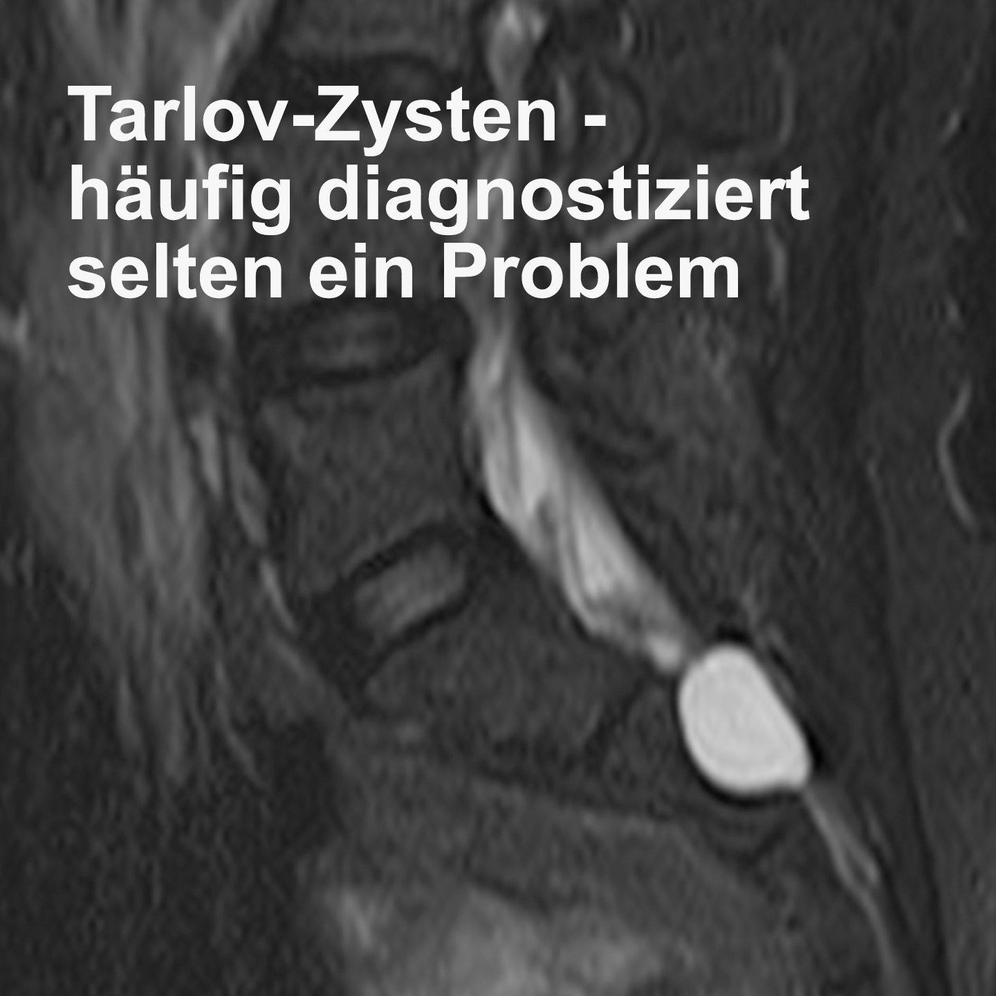 Tarlov-Zysten - häufig diagnostiziert selten ein Problem