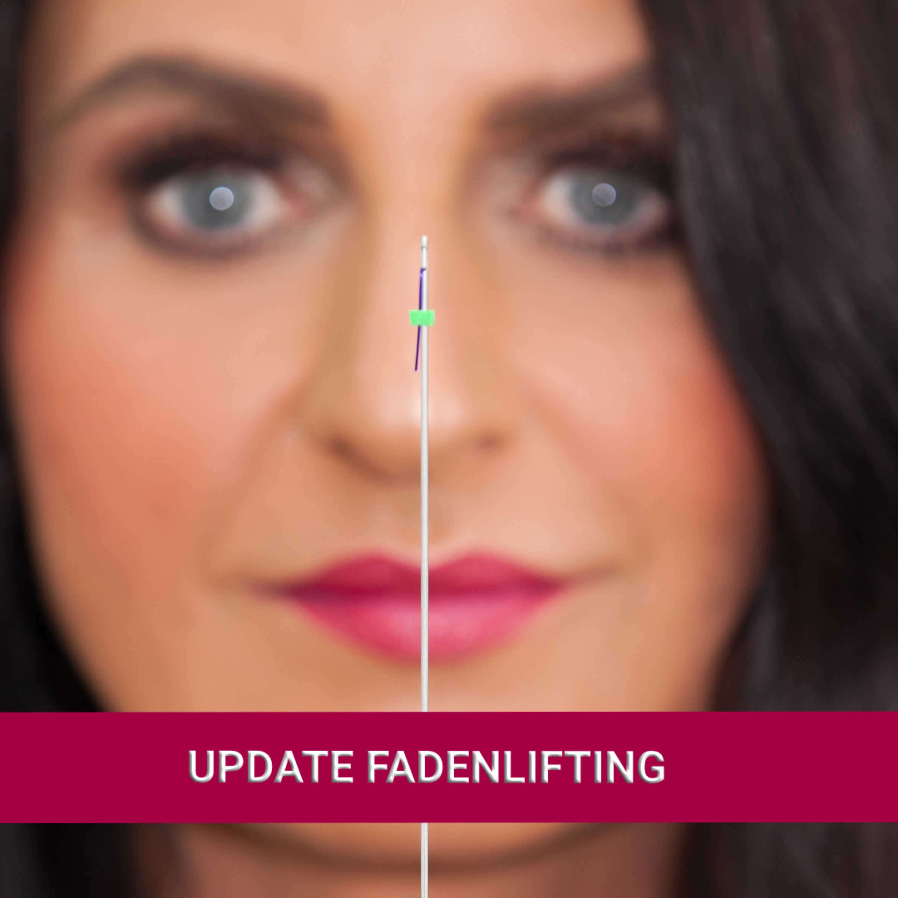 Update Fadenlifting