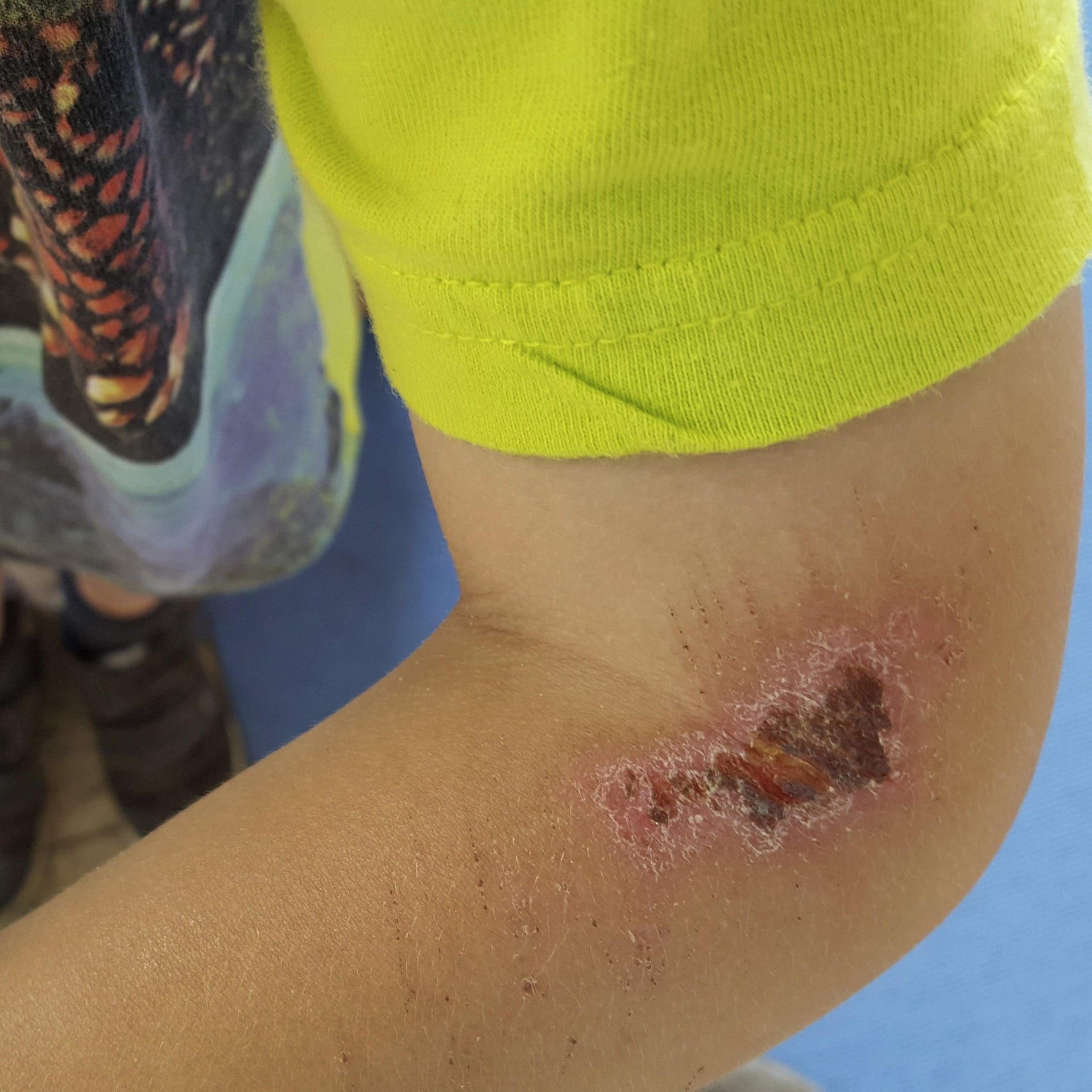 Warum jucken Wunden, wenn sie heilen?