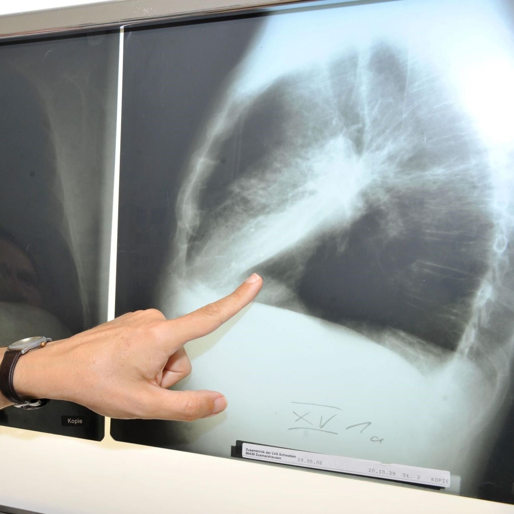 Weltkrebstag: Wo stehen wir im Kampf gegen die Krankheit?