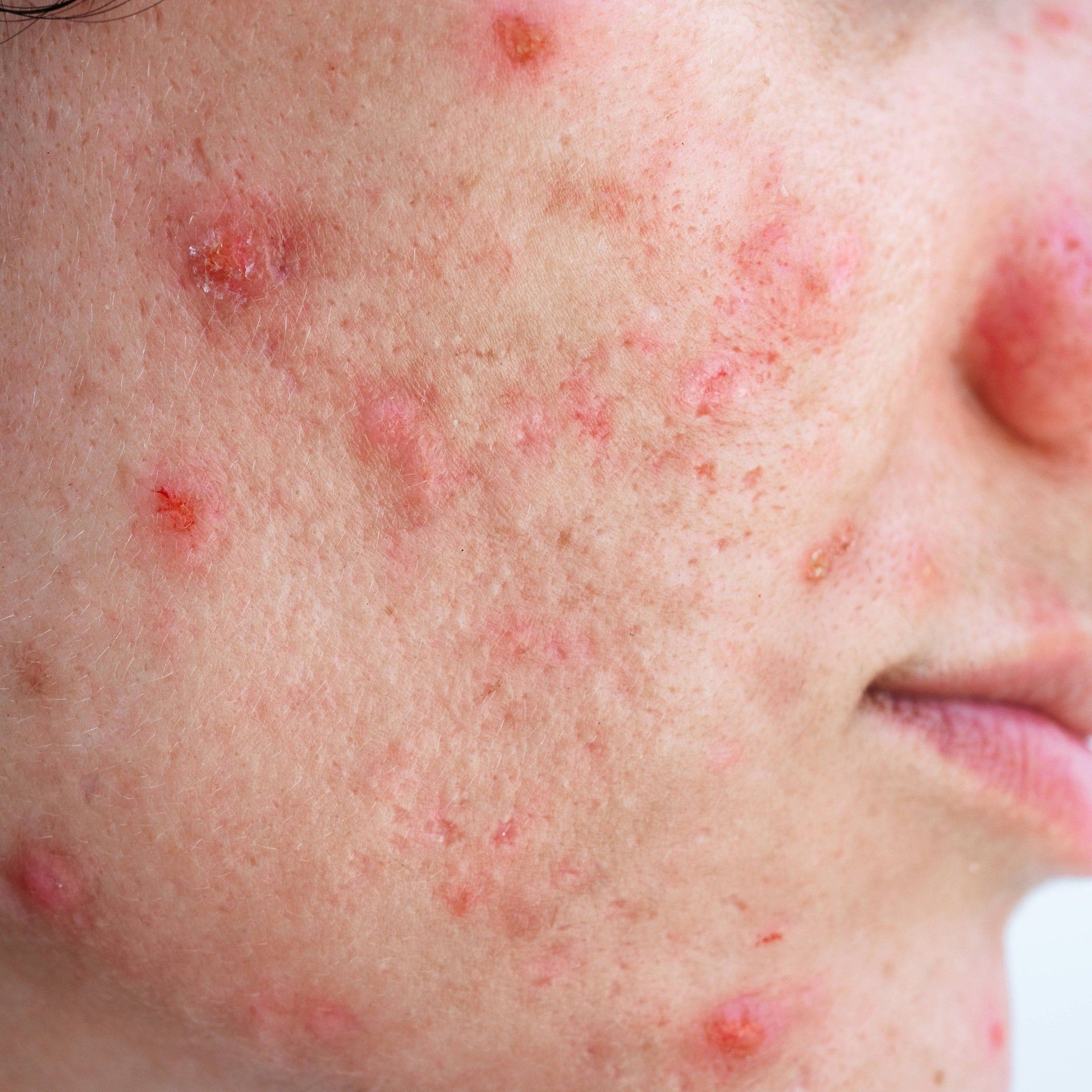 Wie Übergewicht mit Hautkrankheiten zusammenhängt