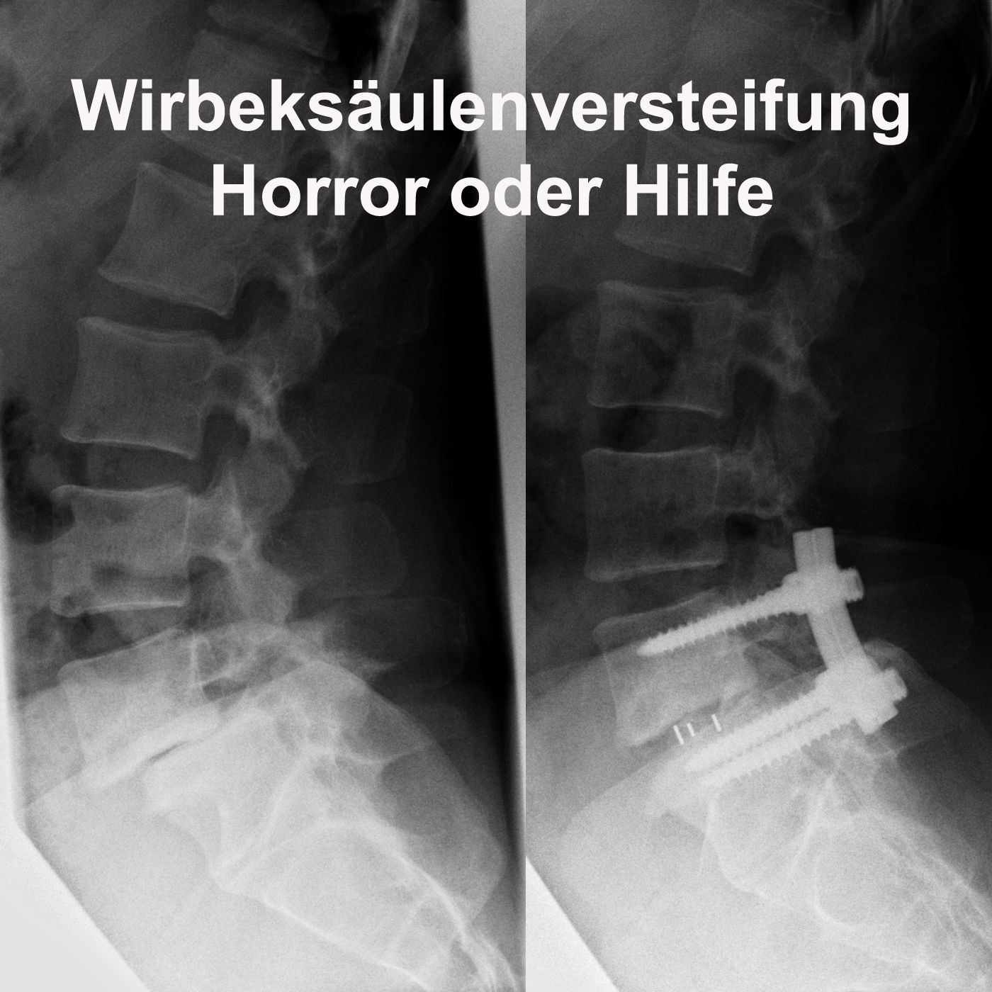 Wirbelsäulenversteifung - Horror oder Hilfe